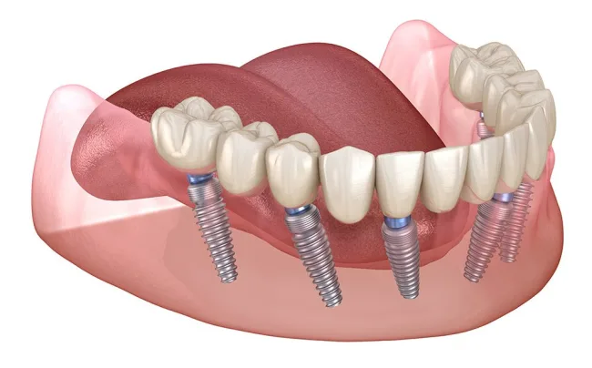 Getting All On 6 Dental Implants Is Better For You