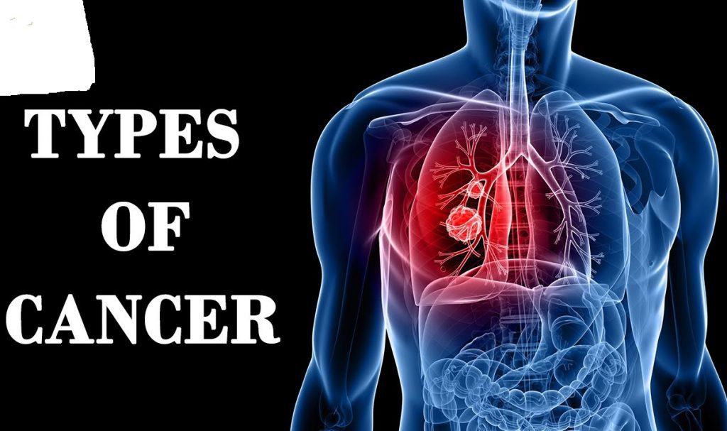 Types of Cancer That Are Often Misdiagnosed